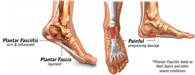 Heel Pain